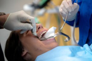 Wisdom Teeth Removal